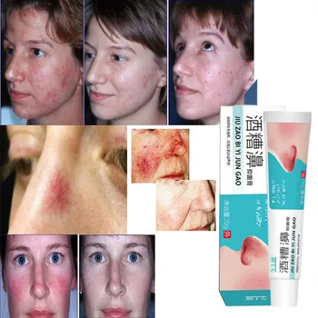 Herbal Anti Tungau Hidung Menghilangkan Jerawat Rosacea Cream Penghilang Komedo Hidung Merah Pengobatan Jerawat Mengecilkan Pori-pori Salep Pemutih Wajah